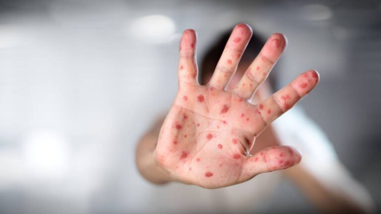 Autoridades sanitarias instan a la población a completar el esquema de vacunación contra el sarampión